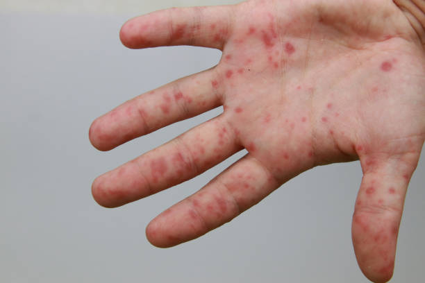 istock Hand foot and mouth disease 2178725797
