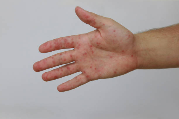 istock Hand foot and mouth disease 2178725863