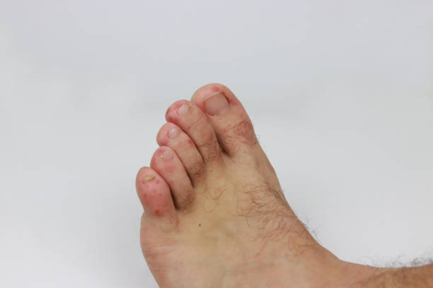 Coxsackie virus hand foot mouth