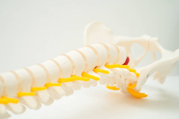 istock Spinal nerve and bone, Lumbar spine displaced herniated disc fragment, Model for treatment medical in the orthopedic department. 2179225702