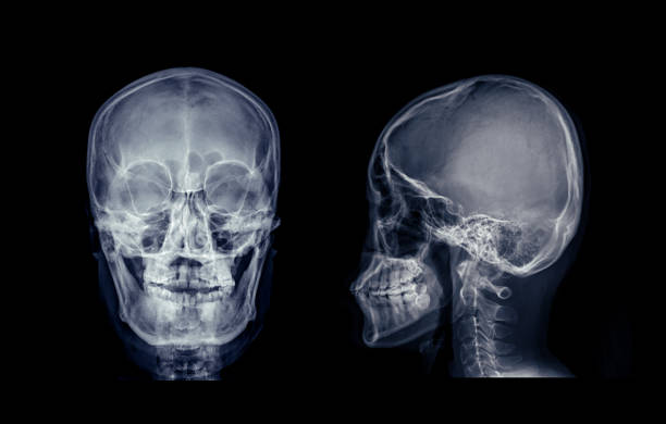 istock X-ray image of the skull in AP (anterior-posterior) view, displaying clear bone structure with no visible abnormalities. 2179483888