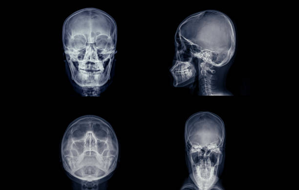 istock X-ray image of the skull in collection, displaying clear bone structure with no visible abnormalities. 2179483940