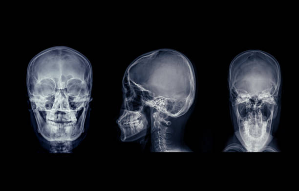 istock X-ray image of the skull in series view, displaying clear bone structure with no visible abnormalities. 2179483949
