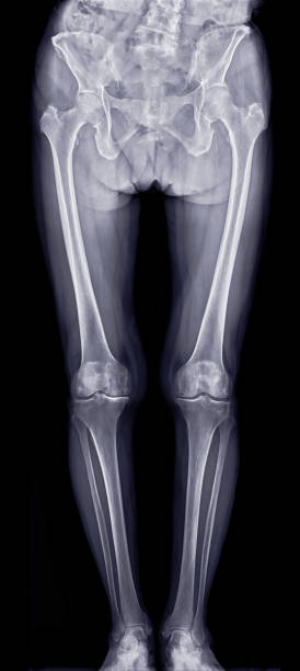 istock Scanogram image displaying the pelvis, femur, and tibia in alignment, commonly used for assessing leg length discrepancies. 2179484080