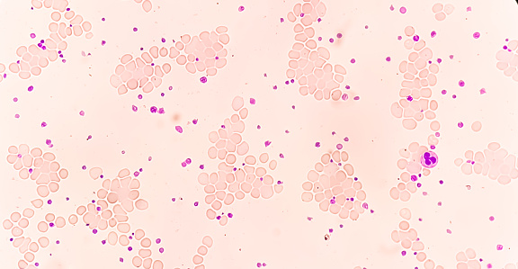 Present Abnormal Thrombocytosis Blood Smear Present Abnormal High Platelet Count Analyze ...