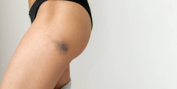 istock Large blue bruise on a woman's leg 2179670028