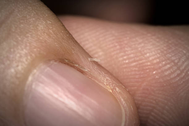 istock Close up of hangnail on finger 2179805352