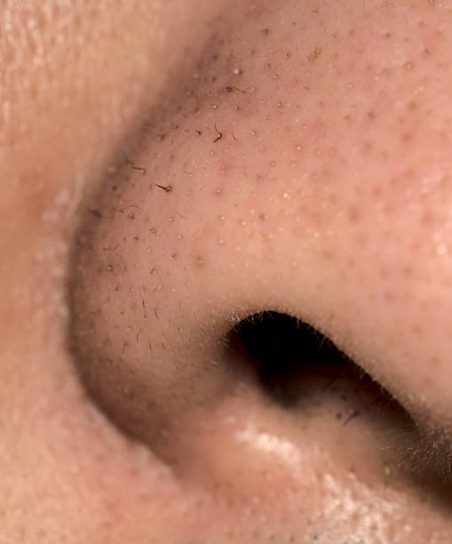 istock close up of blackheads on nose 2179805372