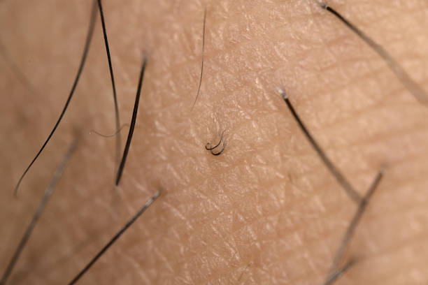 Close up of Ingrown Hair