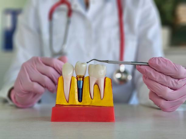 istock Dental professional demonstrating tooth implant procedure using a model 2180038817