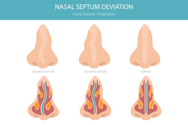 Nose Deviated Septum. Nasal diseases. Medical infographic design Nose Deviated Septum. Nasal diseases. Medical infographic design. Vector illustration septum stock illustrations