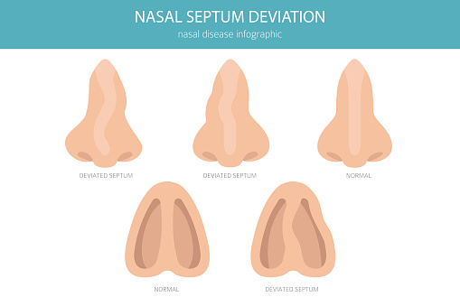 Sept Nazal Nose Deviated Septum Nasal Diseases Medical Infographic Design Stock ...