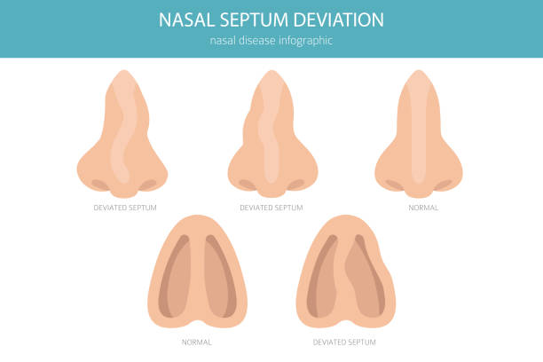 Nose Deviated Septum. Nasal diseases. Medical infographic design Nose Deviated Septum. Nasal diseases. Medical infographic design. Vector illustration septum stock illustrations