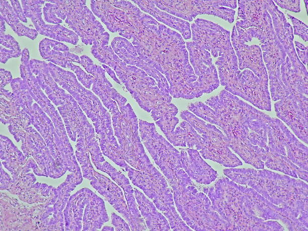 istock photomicrograph of Ectopic pregnancy, Fallopian tube biopsy, microscopic view. 2180102666