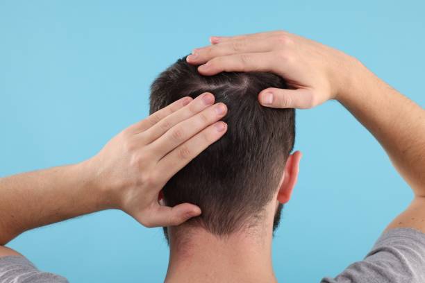 istock Man with dandruff in his dark hair on light blue background, back view 2180140260