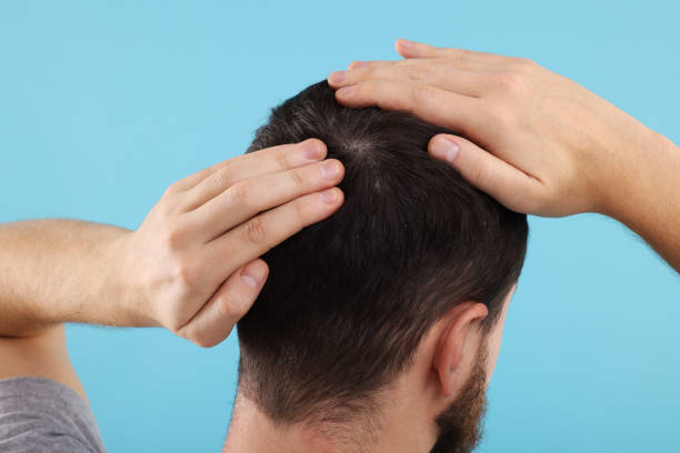 istock Man with dandruff in his dark hair on light blue background, closeup 2180140375