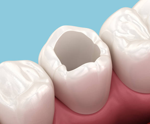 istock Decayed tooth preparation for composite filling. Dental 3D illustration 2180207597