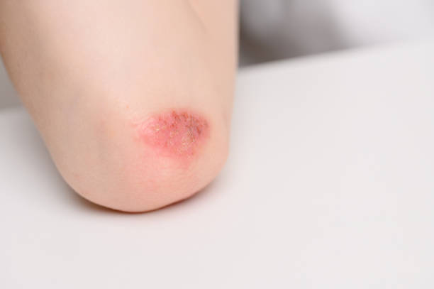 istock Reddened, inflamed areas with scabs on child elbow, hand stands on white table, close-up.Child suffers from attacks of allergies and dermatitis. Dermatological skin diseases concept 2180296878