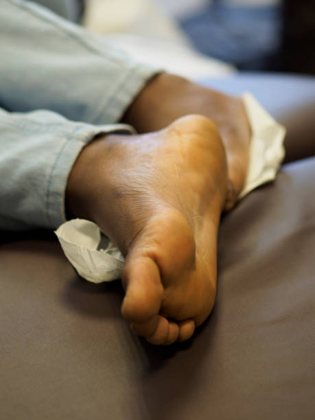 Dry, Cracked & Peeling Feet. feet Infection of the outer epidermis. Skin diseases, Foot Fungus. There is a foot infection caused by diabetes\nbackground, medical, infected, infection, injury, isolated, keratin, kids, macro, man, manicure, medicine, human, mental, nail, nail biting, onychophagia, onychophagy, oral, outer layer, pain, psoriasis, skin, hygiene, healthy, bacteria, disease, behavior, biotin, biting, care, check up, children, closeup, cut, dermatology, dirty, disorder, healthcare, epidermis, finger, fingernails, fingers, foot, fungus, germ, habit, hand, health, white