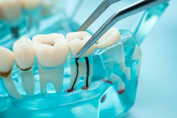 istock Dental teeth model with dentist tool for dentistry. 2180692709