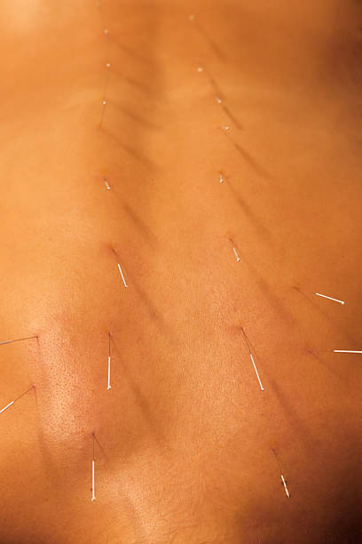 istock Close-up of acupuncture treatment on the back 2180747084