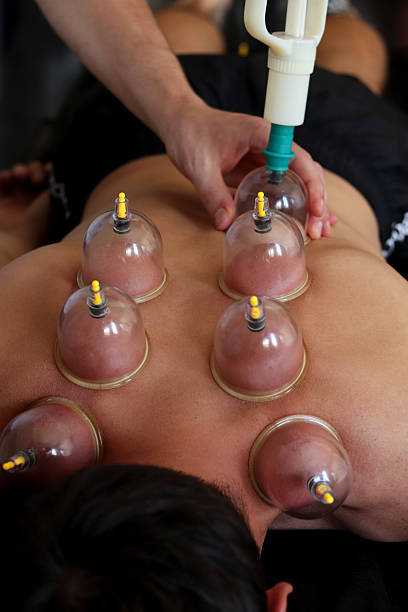 Cup massage close up. Cups for massage on the man's back. Cup massage. Massage vacuum banks. Close-up of man lying with cups on his back in spa salon. Vacuum jars in treatment and cosmetology. Vacuum cup therapy. cupping therapy stock pictures, royalty-free photos & images