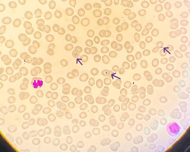 Plasmodium falciparum as observed under a microscope Plasmodium falciparum is a protozoan parasite and the most lethal species responsible for malaria in humans. The trophozoite stage plays a crucial role in its life cycle, occurring after the parasite has invaded red blood cells. Arrows indicate the trophozoites. malaria blood sample stock pictures, royalty-free photos & images