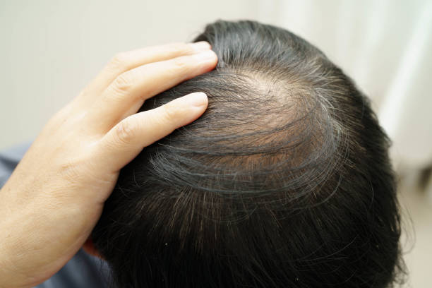 istock Bald head in man, hair loss treatment health problem. 2181089244