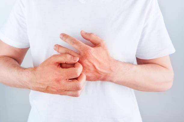 istock Man scratches or shows hands with dry, cracked skin on white backgrounds. Problem with many people - eczema on hand, allergies or dry skin. Health care concept. Close up. 2181210482