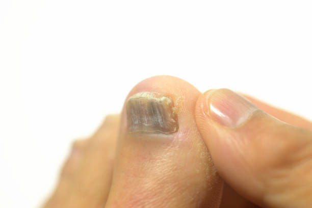 istock Close-up of athlete's foot 2181299680