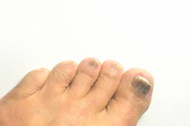 istock Close-up of athlete's foot 2181299712