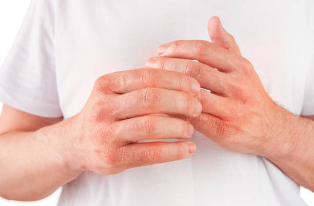 istock Man scratches or shows hands with dry, cracked skin on white backgrounds. Problem with many people - eczema on hand, allergies or dry skin. Health care concept. Close up. 2181339243
