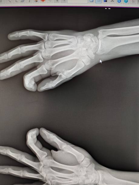 istock X-ray image of pisiform bone fracture after falling on wrist 2181404401