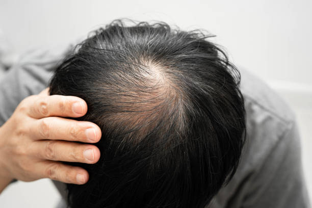 istock Bald head in man, hair loss treatment health problem. 2181446851