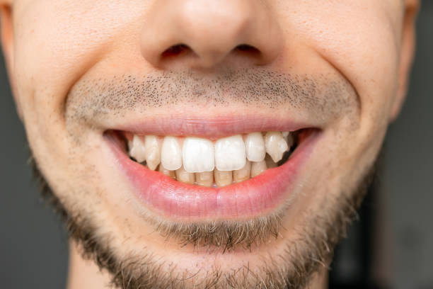 istock Close-up of a man's smile with visible crooked teeth 2181490670
