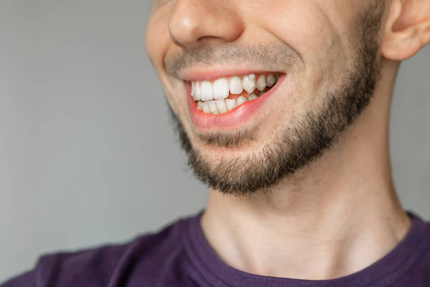 istock Close-up of smiling man showing crooked teeth with beard 2181490676