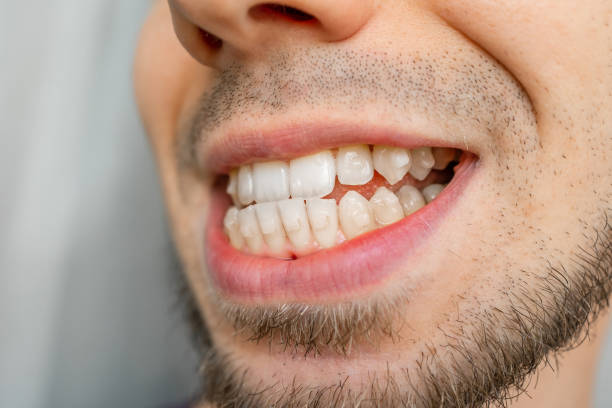istock Close-up of a smiling face with visible crooked teeth 2181490679