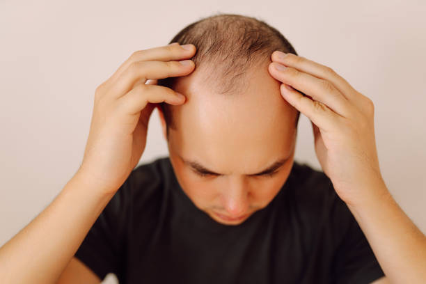 istock Baldness on the head of a middle-aged man. 2181562988