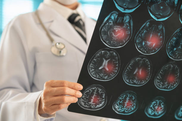 istock Doctor radiology looking stroke brain x-ray image for diagnose ischemic stroke or cerebrovascular disease at hospital. 2181652346