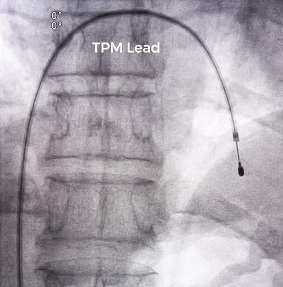 Single Lead Pacmaker X Ray Image Show That Single Chambers Permanent Pacemaker Leads Was ...
