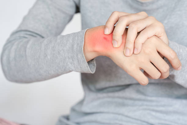 istock Skin irritation can be uncomfortable and concerning, as shown by redness on wrist. Its important to identify cause and seek appropriate care 2181680317