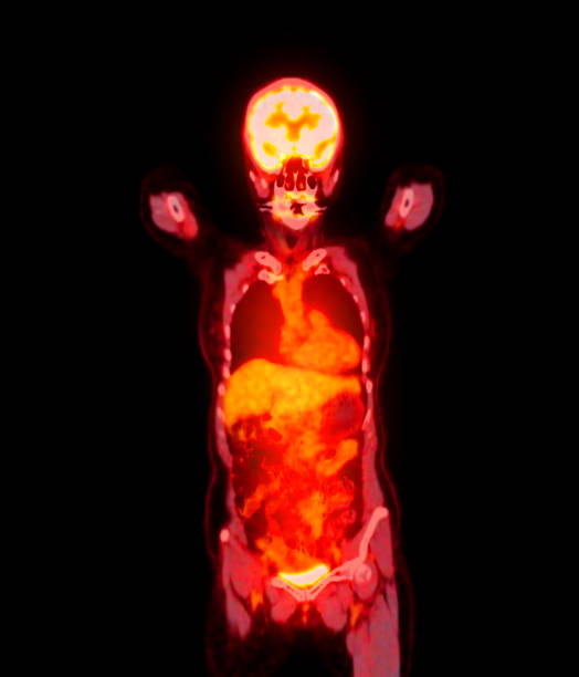istock PET scan image displaying whole-body metabolic activity in a side profile view. Suitable for medical education, diagnostics, and research in cellular function. 2181746476