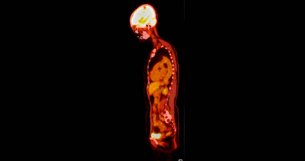 istock PET scan image displaying whole-body metabolic activity in a side profile view. Suitable for medical education, diagnostics, and research in cellular function. 2181747037