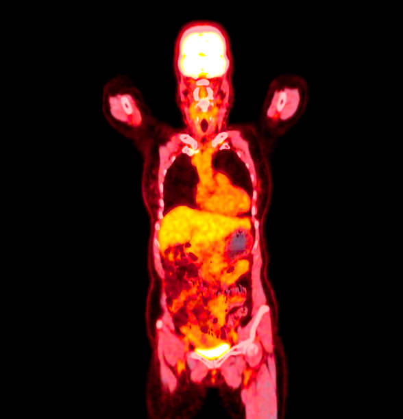 istock PET scan image displaying whole-body metabolic activity in a side profile view. Suitable for medical education, diagnostics, and research in cellular function. 2181747206
