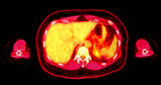 istock PET scan image displaying whole-body metabolic activity in a side profile view. Suitable for medical education, diagnostics, and research in cellular function. 2181747286
