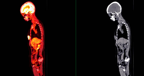 istock PET scan image displaying whole-body metabolic activity in a side profile view. Suitable for medical education, diagnostics, and research in cellular function. 2181747326