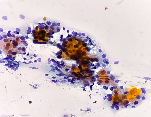 istock Microscopic image (photomicrograph) of Hashimoto's thyroiditis, an autoimmune disorder of the thyroid that can lead to hypothyroidism 2181855700