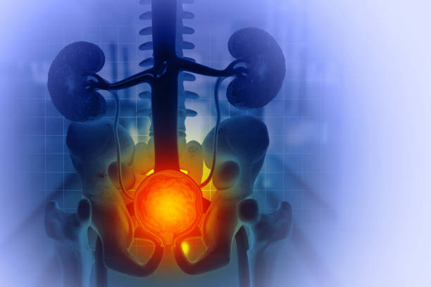 Prostate disease, Benign prostatic hyperplasia (BPH), Prostate cancer. 3d illustration Prostate disease, Benign prostatic hyperplasia (BPH), Prostate cancer. 3d illustration prostate stock pictures, royalty-free photos & images