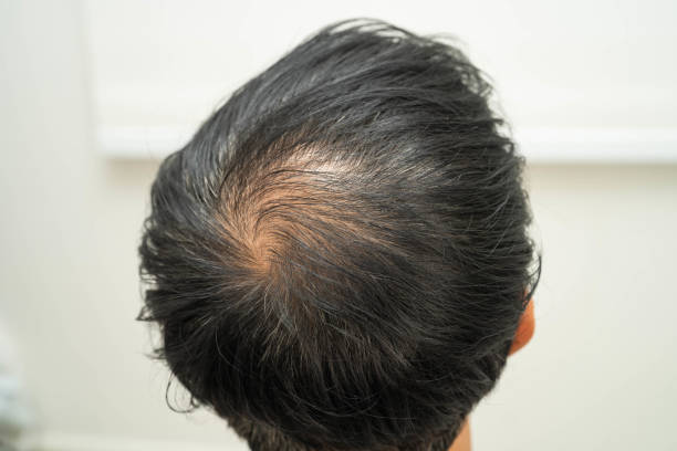 istock Bald head in man, hair loss treatment health problem. 2182072759