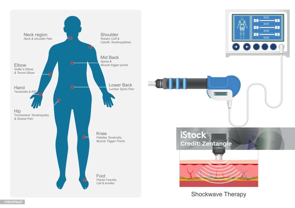 Extracorporeal Shock Wave Therapy Treatment Stock Illustration extracorporeal-shock-wave-therapy-treatment-stock-illustration